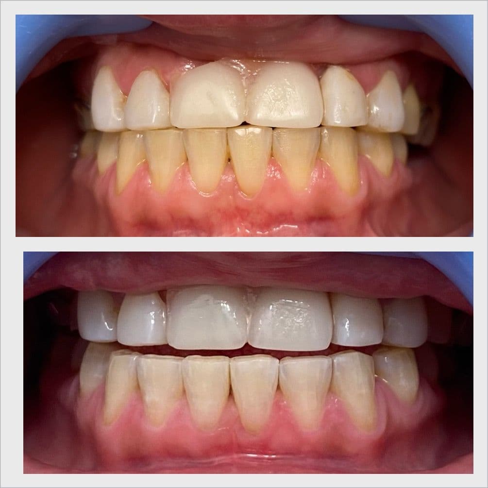 Teeth whitening before and after result - Client 1