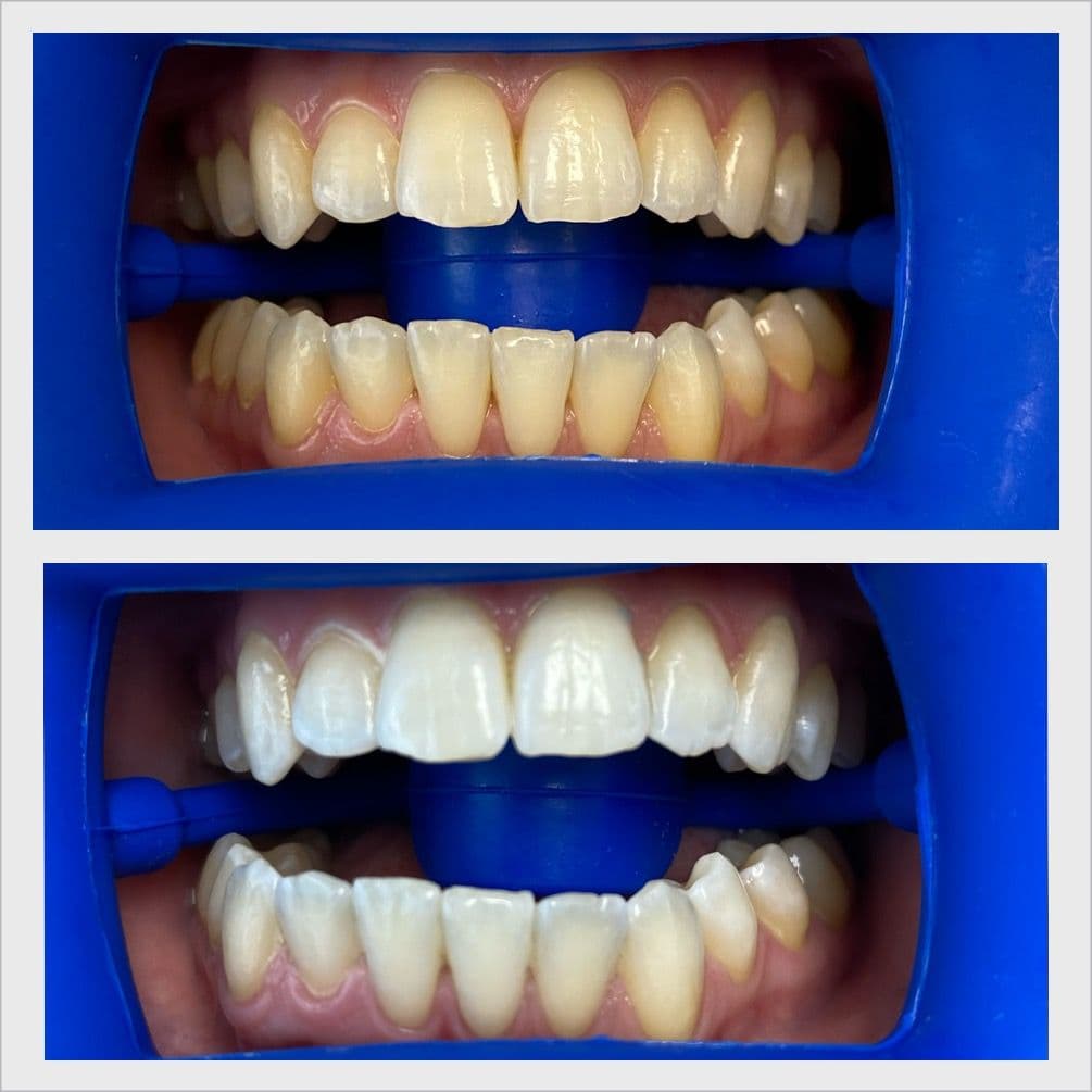 Teeth whitening before and after result - Client 2