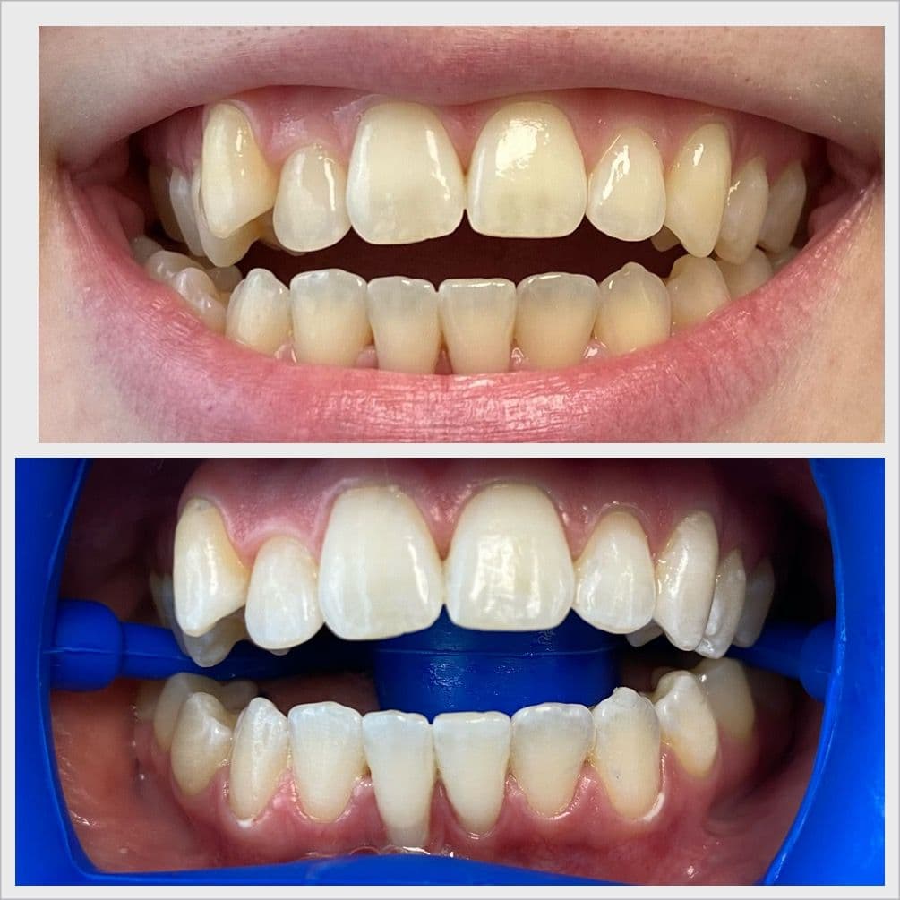 Teeth whitening before and after result - Client 3