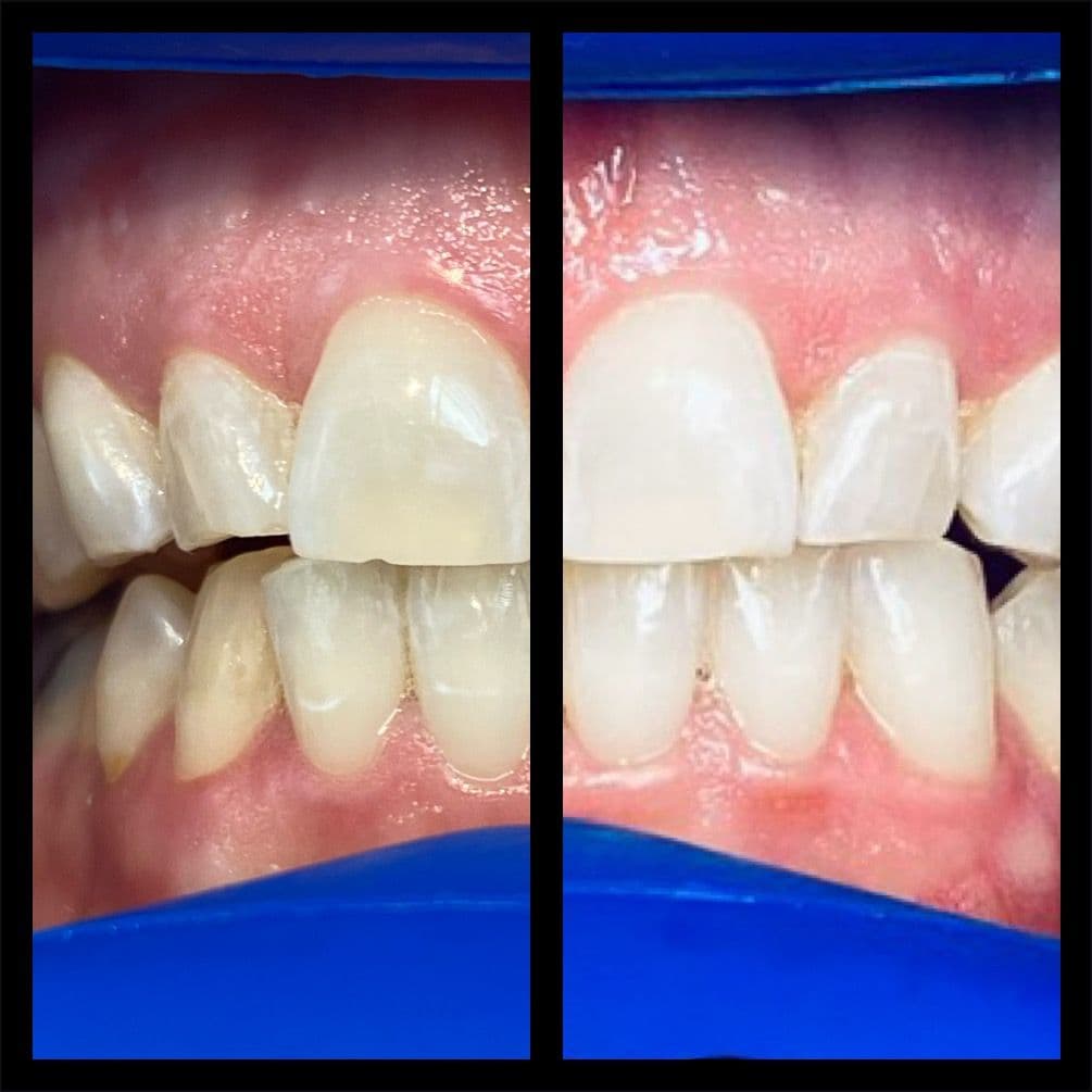 Teeth whitening before and after result - Client 4