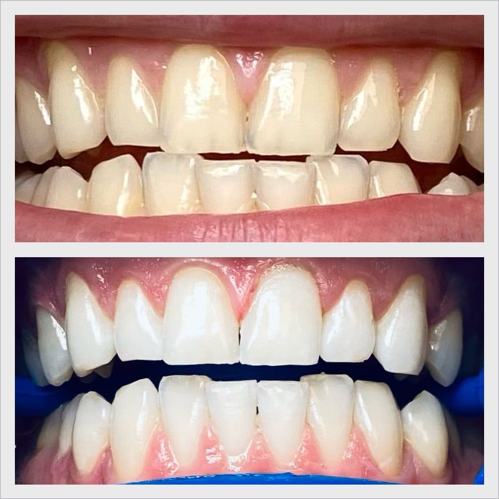 Teeth whitening before and after result - Client 5