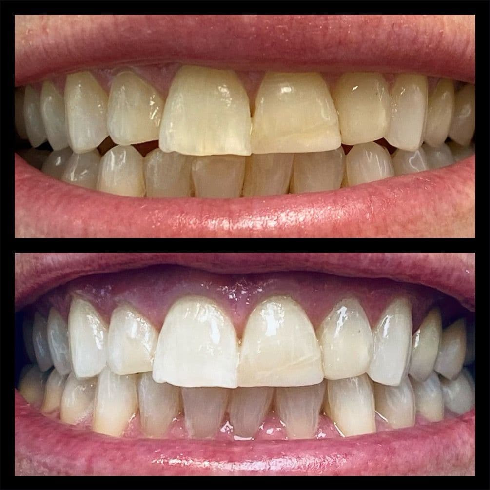 Teeth whitening before and after result - Client 6