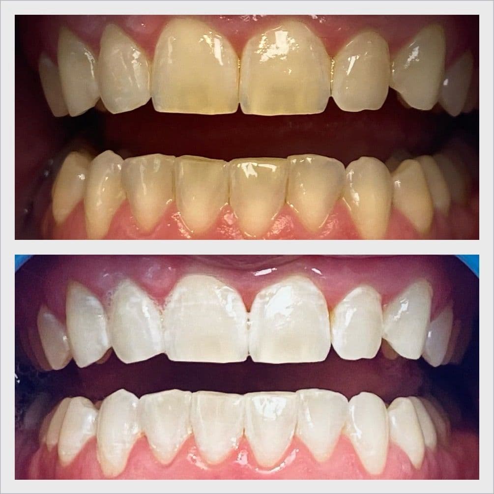 Teeth whitening before and after result - Client 7