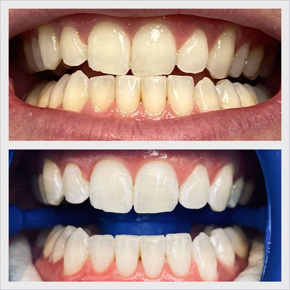 Teeth whitening before and after result - Client 8