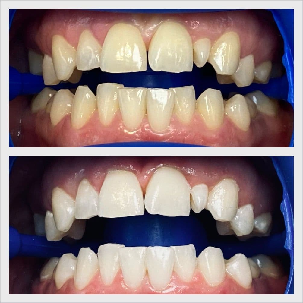 Teeth whitening before and after result - Client 9