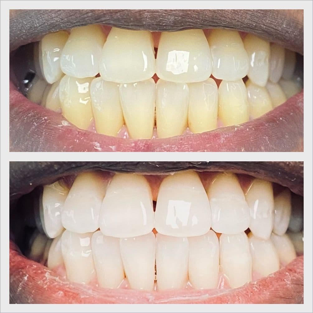 Teeth whitening before and after result - Client 10